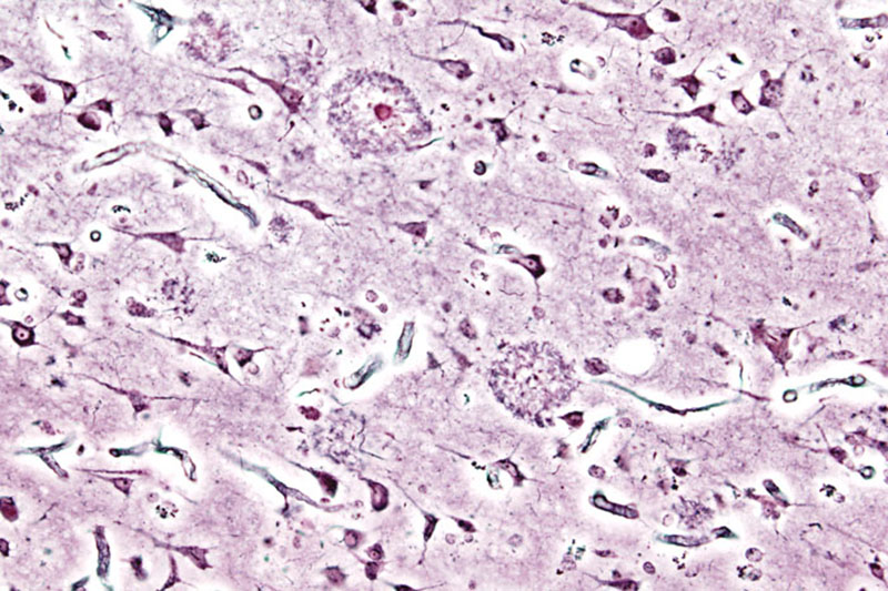 Imagen histopatológica de placas seniles vista en la corteza cerebral de un paciente con la enfermedad de Alzheimer.